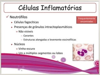 Células Inflamatórias
 Neutrófilos
► Células fagocíticas
► Presenças de grânulos intracitoplasmáticos
 Não visíveis
– Corantes
– Estruturas alongadas e levemente eosinofílicas
► Núcleos
 Vinho-escuro
 Um a múltiplos segmentos ou lobos
Frequentemente
encontradas
 