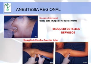 ANESTESIA REGIONAL
Bloqueio de Membro Superior Axilar
Bloqueio Intercostal
Usada para cirurgia de nódulo de mama
BLOQUEIO DE PLEXOS
NERVOSOS
 