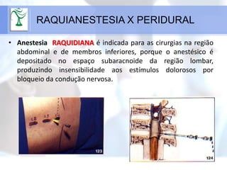 • Anestesia RAQUIDIANA é indicada para as cirurgias na região
abdominal e de membros inferiores, porque o anestésico é
depositado no espaço subaracnoide da região lombar,
produzindo insensibilidade aos estímulos dolorosos por
bloqueio da condução nervosa.
RAQUIANESTESIA X PERIDURAL
 