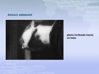 ÁNGULO ABERRANTEplano inclinado hacia un lado.