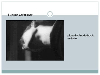 ÁNGULO ABERRANTE




                   plano inclinado hacia
                   un lado.
 