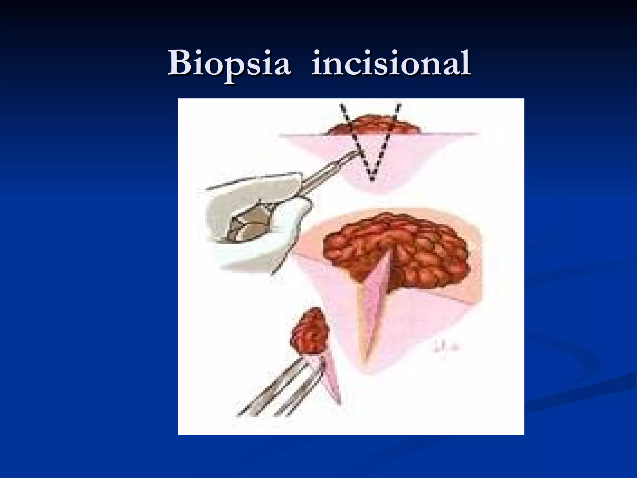 Biopsia incisional