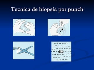 Tecnica de biopsia por punch 