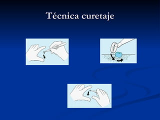Técnica curetaje