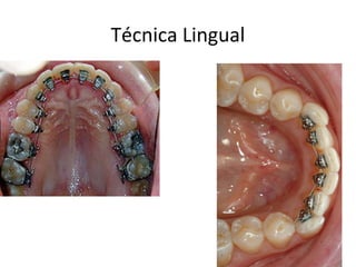 Técnica Lingual
 