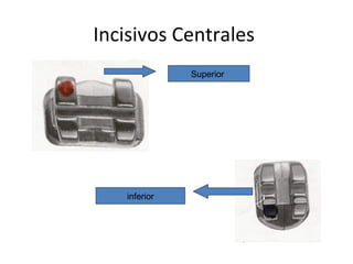 Incisivos Centrales
Superior
inferior
 