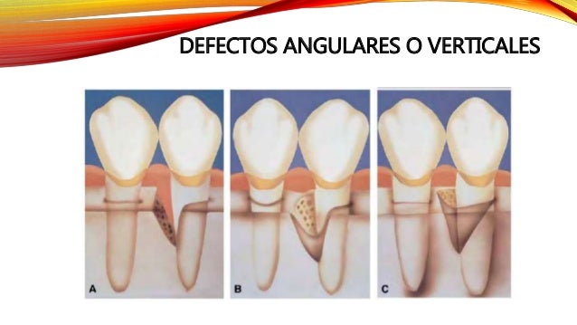 Tipos de defectos óseos, Cirugia resectiva de los tejidos blandos