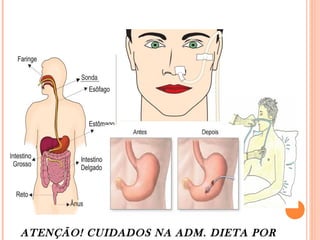 ATENÇÃO! CUIDADOS NA ADM. DIETA POR
 