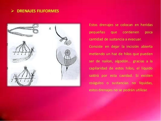 Tipos de drenaje