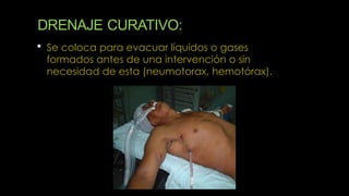 DRENAJE CURATIVO:
 Se coloca para evacuar líquidos o gases
formados antes de una intervención o sin
necesidad de esta (neumotorax, hemotórax).
 