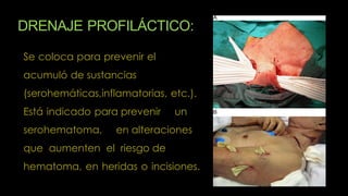 DRENAJE PROFILÁCTICO:
Se coloca para prevenir el
acumuló de sustancias
(serohemáticas,inflamatorias, etc.).
Está indicado para prevenir un
serohematoma, en alteraciones
que aumenten el riesgo de
hematoma, en heridas o incisiones.
 