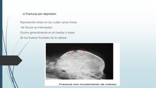 c) Fracturas por depresión
Representan áreas en las cuales varias líneas
de fisuras se interceptan.
Ocurre generalmente en el maxilar o áreas
de los huesos frontales de la cabeza.
 