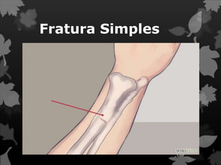 Fratura Simples
 