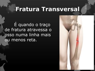 Fratura Transversal
É quando o traço
de fratura atravessa o
osso numa linha mais
ou menos reta.
 