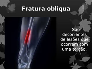 Fratura oblíqua
São
decorrentes
de lesões que
ocorrem com
uma torção.
 