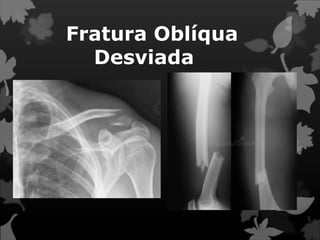 Fratura Oblíqua
Desviada
 