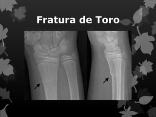 Fratura de Toro
 