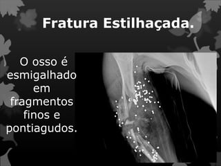 Fratura Estilhaçada.
O osso é
esmigalhado
em
fragmentos
finos e
pontiagudos.
 