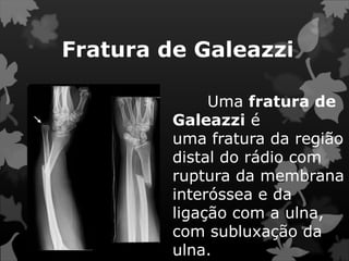 Fratura de Galeazzi
Uma fratura de
Galeazzi é
uma fratura da região
distal do rádio com
ruptura da membrana
interóssea e da
ligação com a ulna,
com subluxação da
ulna.
 