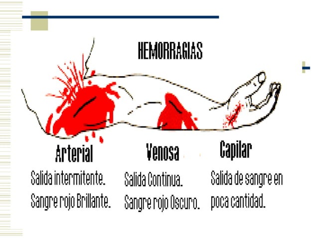 Tipos de hemorragias | PPT