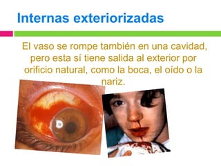 Internas exteriorizadas
El vaso se rompe también en una cavidad,
pero esta sí tiene salida al exterior por
orificio natural, como la boca, el oído o la
nariz.

 