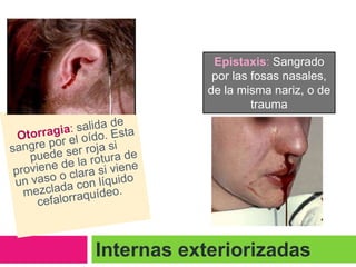 Epistaxis: Sangrado
por las fosas nasales,
de la misma nariz, o de
trauma
craneoencefálico

Internas exteriorizadas

 