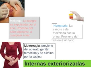 Melenas: La sangre
es expulsada por el
ano. Procede del
tubo digestivo, a
cualquier nivel.

Hematuria: La
sangre sale
mezclada con la
orina. Proviene del
sistema urinario

Metrorragia: proviene
del aparato genital
femenino y se elimina
por la vagina

Internas exteriorizadas

 