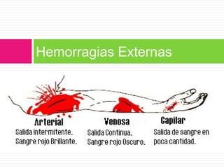Hemorragias Externas

 