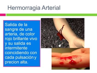 Hermorragia Arterial
Salida de la
sangre de una
arteria, de color
rojo brillante vivo
y su salida es
intermitente
coincidiendo con
cada pulsación y
precion alta.

 
