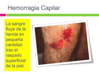 Hemorragia Capilar
La sangre
fluye de la
herida en
pequeña
cantidad
tras el
raspado
superficial
de la piel.

 