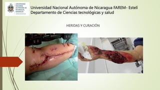 Universidad Nacional Autónoma de Nicaragua FAREM- Estelí
Departamento de Ciencias tecnológicas y salud
HERIDAS Y CURACIÓN
 