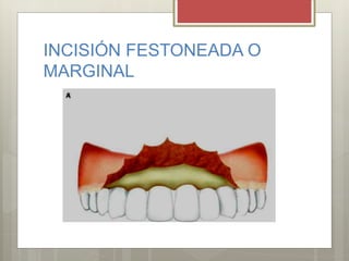 INCISIÓN FESTONEADA O
MARGINAL
 