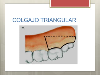 COLGAJO TRIANGULAR
 