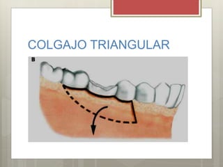 COLGAJO TRIANGULAR
 