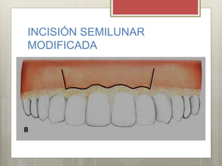 INCISIÓN SEMILUNAR
MODIFICADA
 