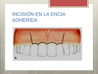 INCISIÓN EN LA ENCIA
ADHERIDA
 