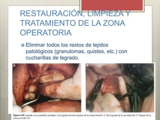 RESTAURACIÓN, LIMPIEZA Y
TRATAMIENTO DE LA ZONA
OPERATORIA
 Eliminar todos los restos de tejidos
patológicos (granulomas, quistes, etc.) con
cucharillas de legrado.
 