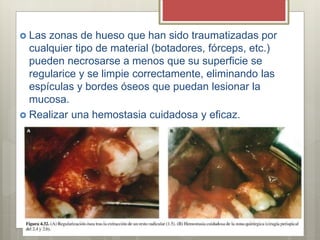  Las zonas de hueso que han sido traumatizadas por
cualquier tipo de material (botadores, fórceps, etc.)
pueden necrosarse a menos que su superficie se
regularice y se limpie correctamente, eliminando las
espículas y bordes óseos que puedan lesionar la
mucosa.
 Realizar una hemostasia cuidadosa y eficaz.
 