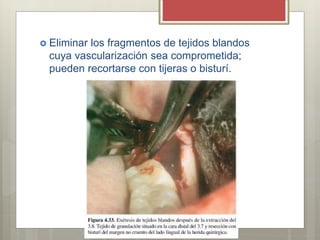  Eliminar los fragmentos de tejidos blandos
cuya vascularización sea comprometida;
pueden recortarse con tijeras o bisturí.
 
