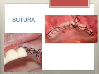 SUTURA
 