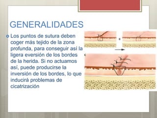 GENERALIDADES
 Los puntos de sutura deben
coger más tejido de la zona
profunda, para conseguir así la
ligera eversión de los bordes
de la herida. Si no actuamos
así, puede producirse la
inversión de los bordes, lo que
inducirá problemas de
cicatrización
 