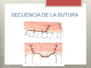 SECUENCIA DE LA SUTURA
 