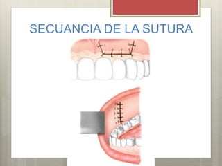 SECUANCIA DE LA SUTURA
 