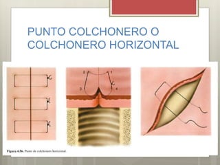 PUNTO COLCHONERO O
COLCHONERO HORIZONTAL
 