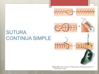 SUTURA
CONTINUA SIMPLE
 
