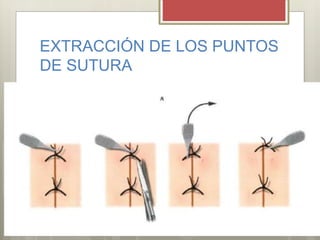 EXTRACCIÓN DE LOS PUNTOS
DE SUTURA
 