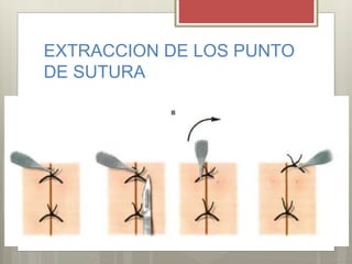 EXTRACCION DE LOS PUNTO
DE SUTURA
 