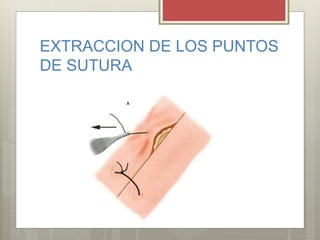 EXTRACCION DE LOS PUNTOS
DE SUTURA
 