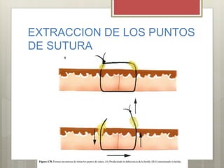 EXTRACCION DE LOS PUNTOS
DE SUTURA
 