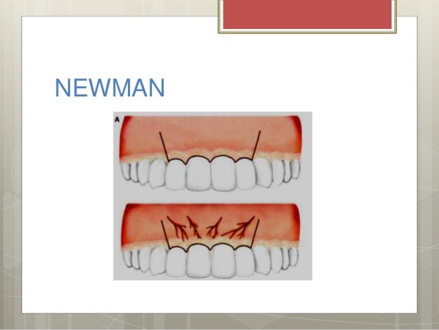 Resultado de imagen para tipos de incisiones en odontologia NEUMAN